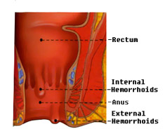 internal hemorrhoids